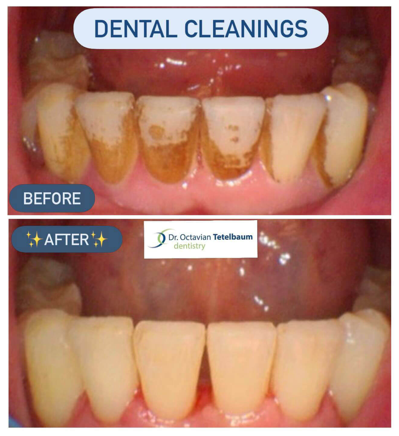 Before and after professional dental cleaning stain removal