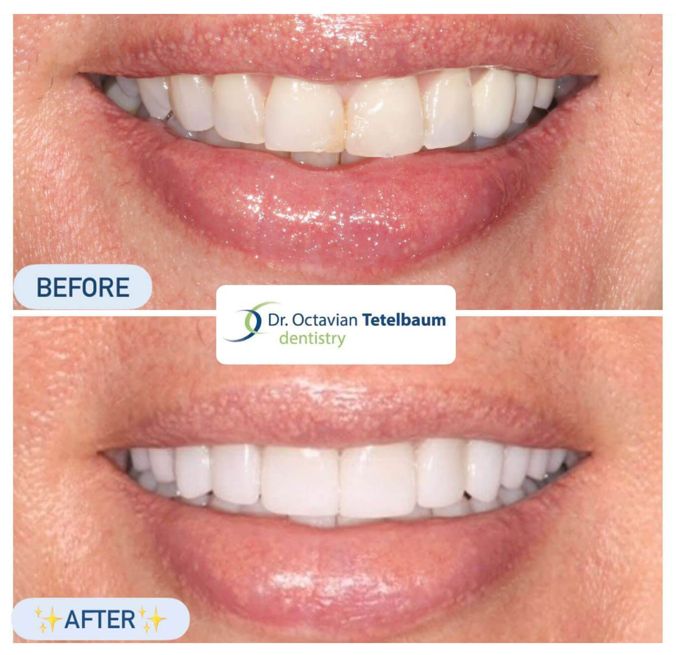 Ceramic Restorations - full mouth reconstruction before and after