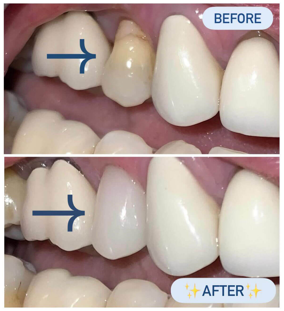 Before and after restoring sensitive tooth with ceramic crown