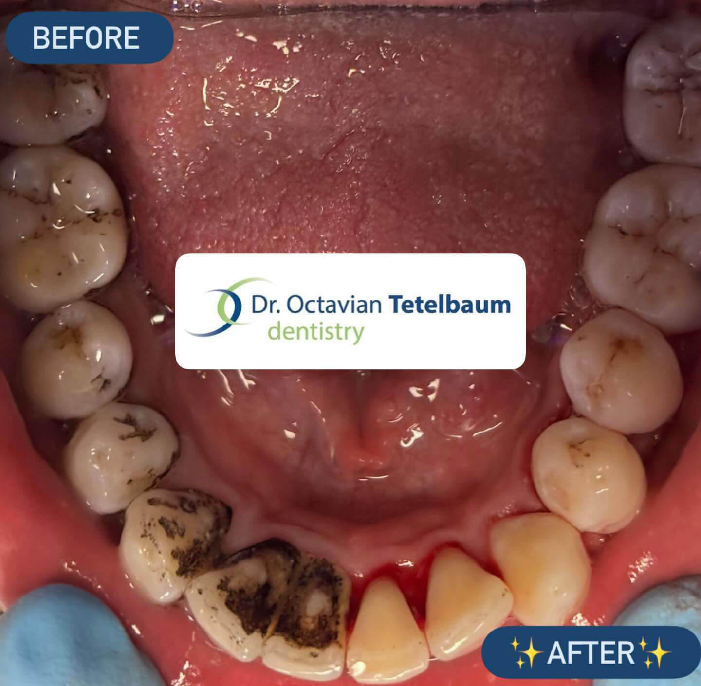 Real-time side-by-side comparison during teeth cleaning procedure